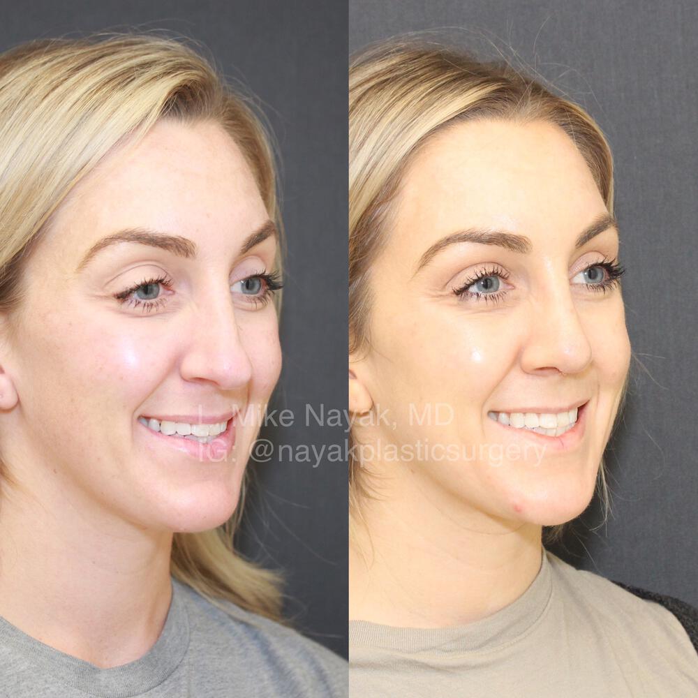 Rhinoplasty Before & After Image