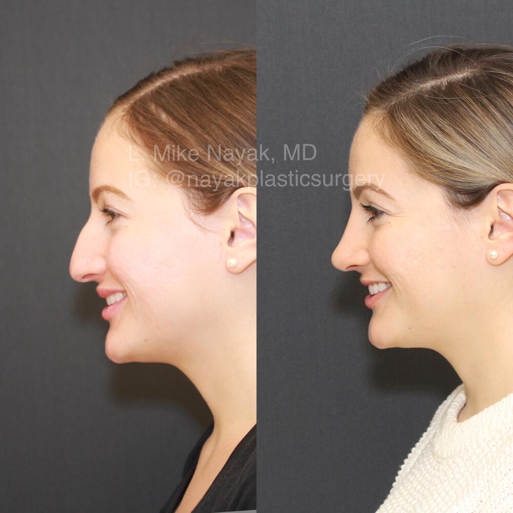 Rhinoplasty Before & After Image