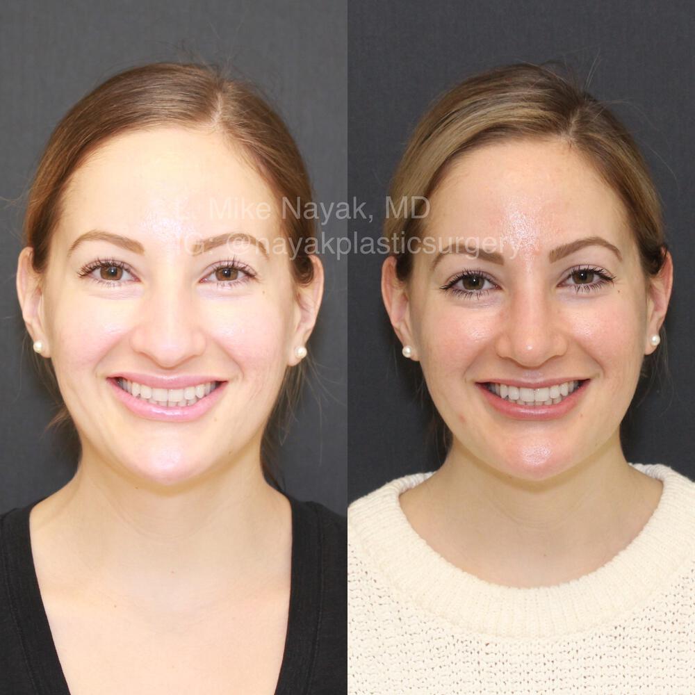 Rhinoplasty Before & After Image