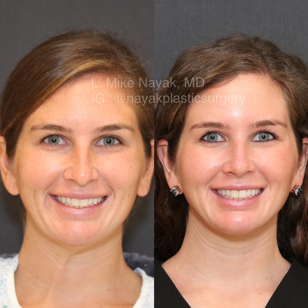 Rhinoplasty Before & After Image