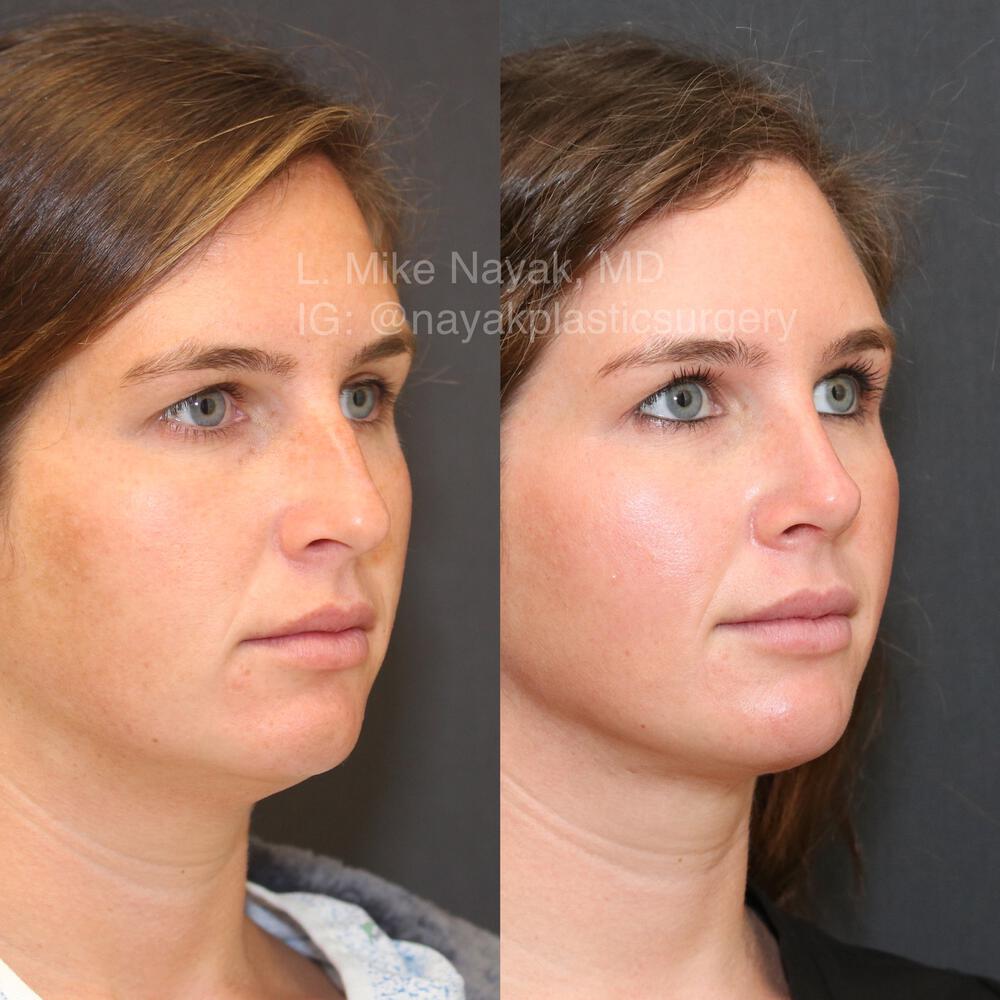 Rhinoplasty Before & After Image