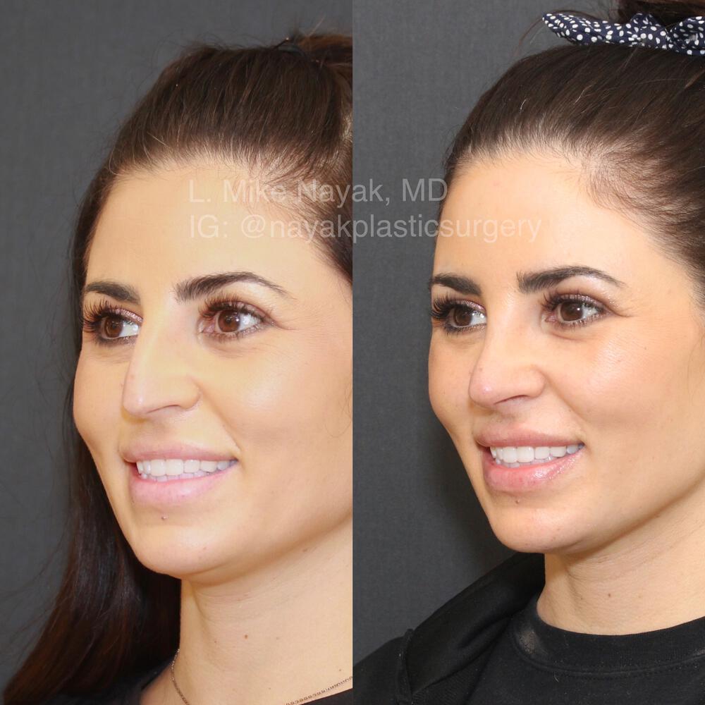 Rhinoplasty Before & After Image