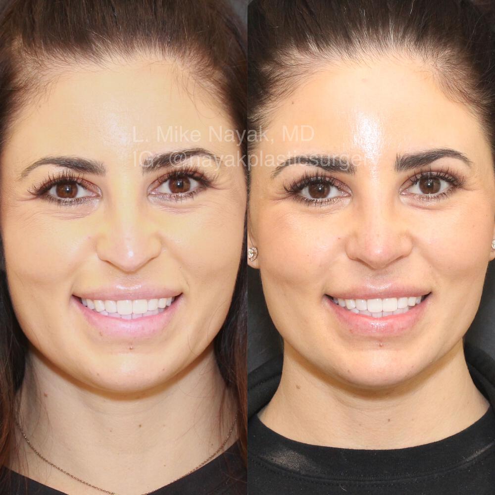 Rhinoplasty Before & After Image