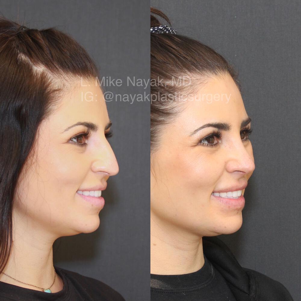 Rhinoplasty Before & After Image