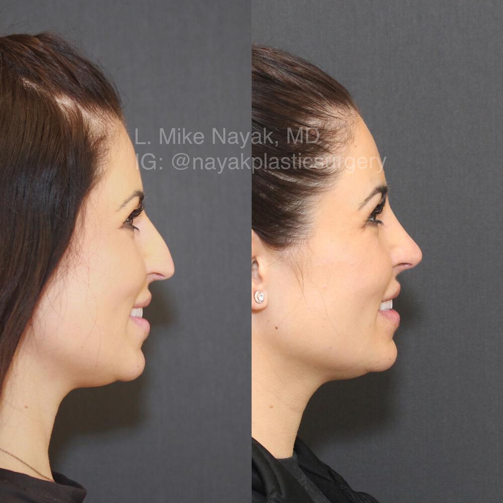 Rhinoplasty Before & After Image