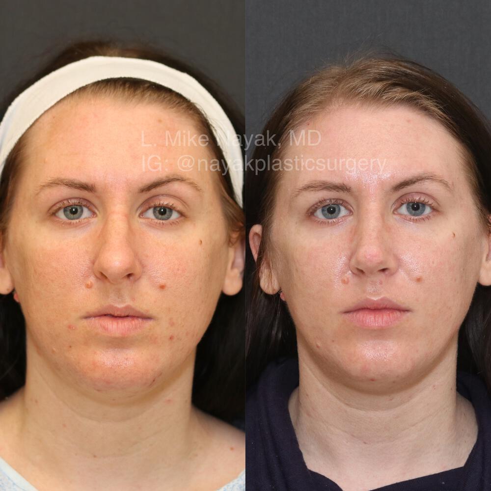 Rhinoplasty Before & After Image