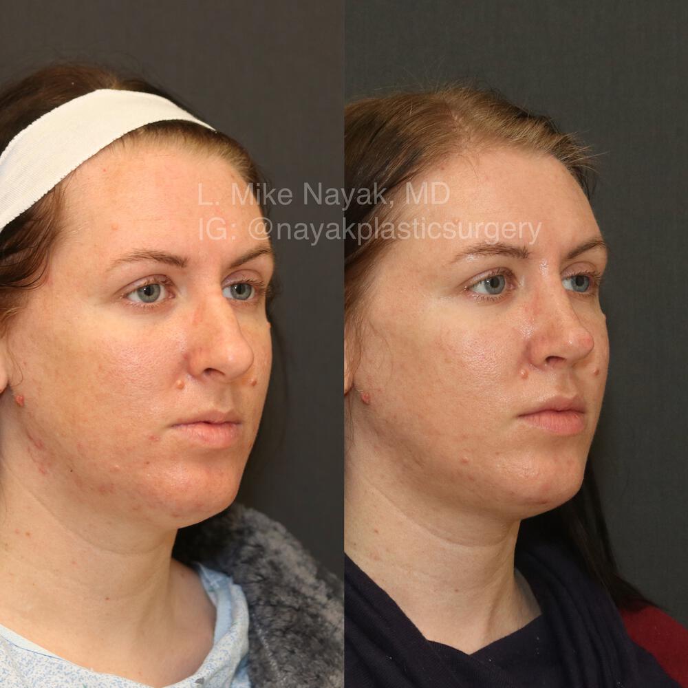 Rhinoplasty Before & After Image