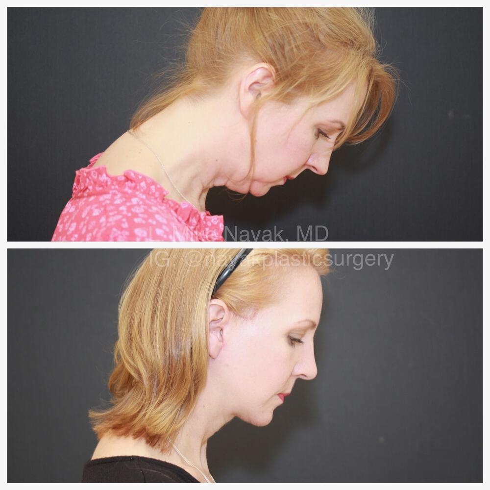 Rhinoplasty Before & After Image