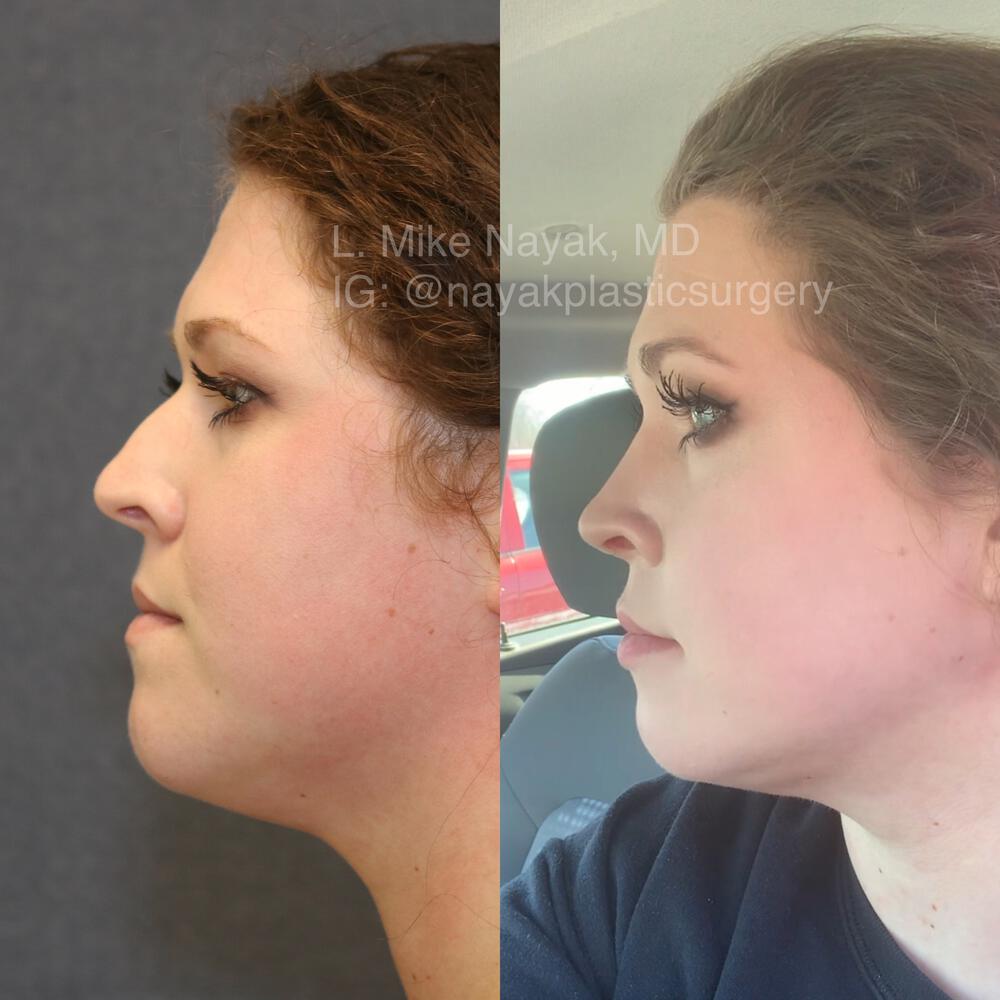 Rhinoplasty Before & After Image