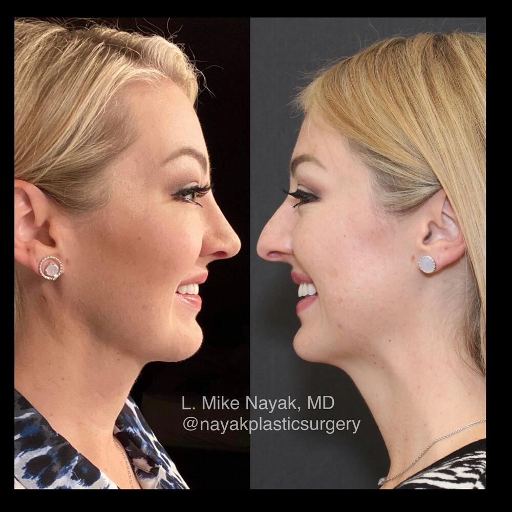 Rhinoplasty Before & After Image