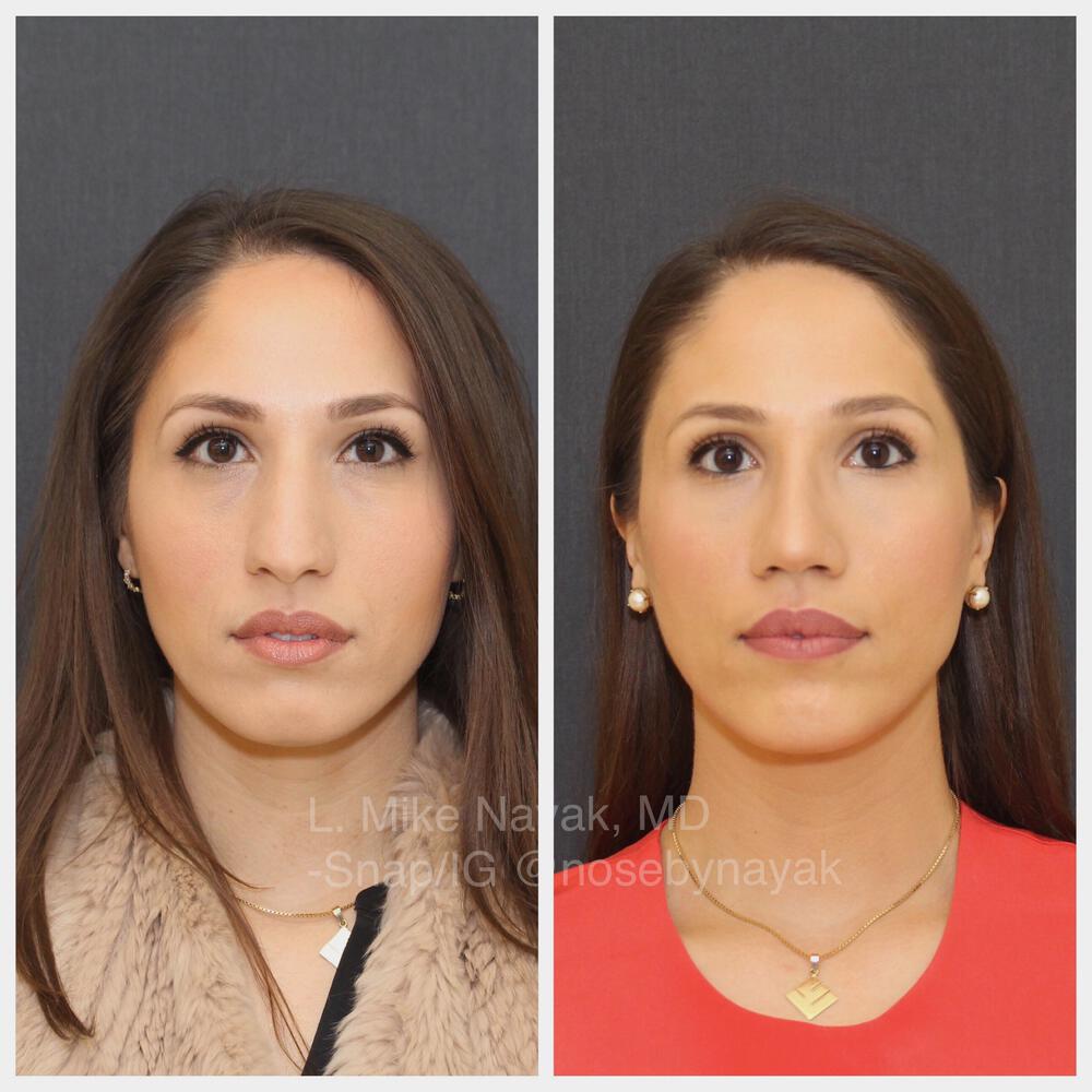 Rhinoplasty Before & After Image