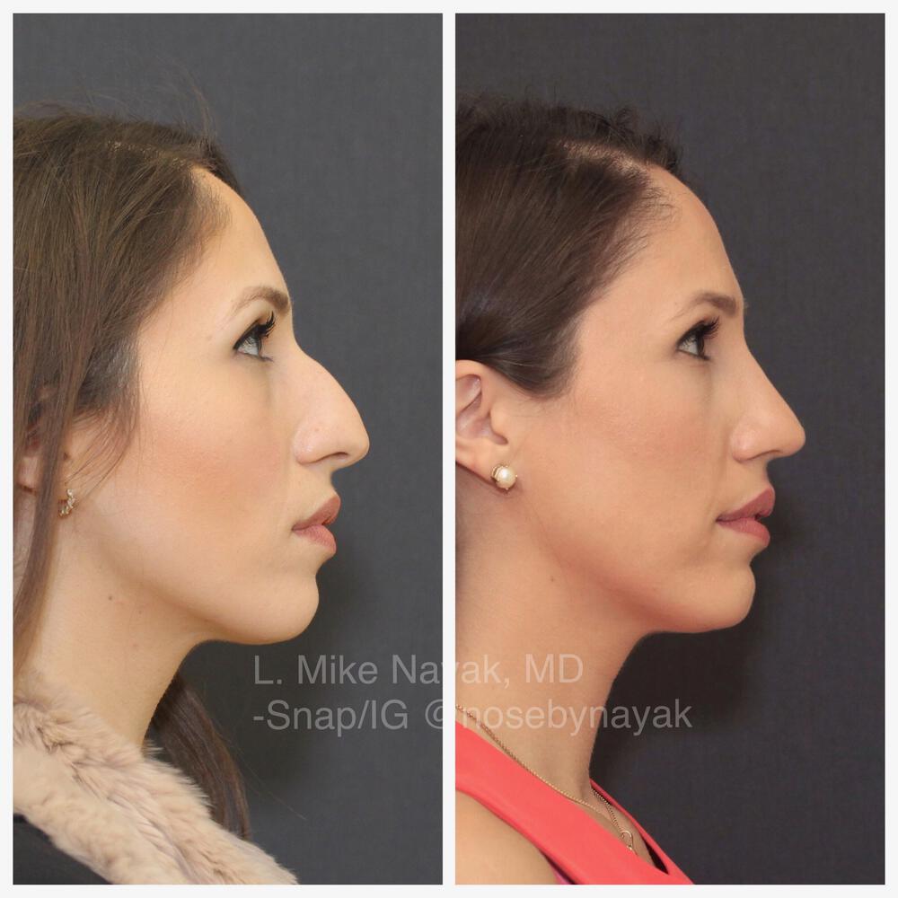 Rhinoplasty Before & After Image