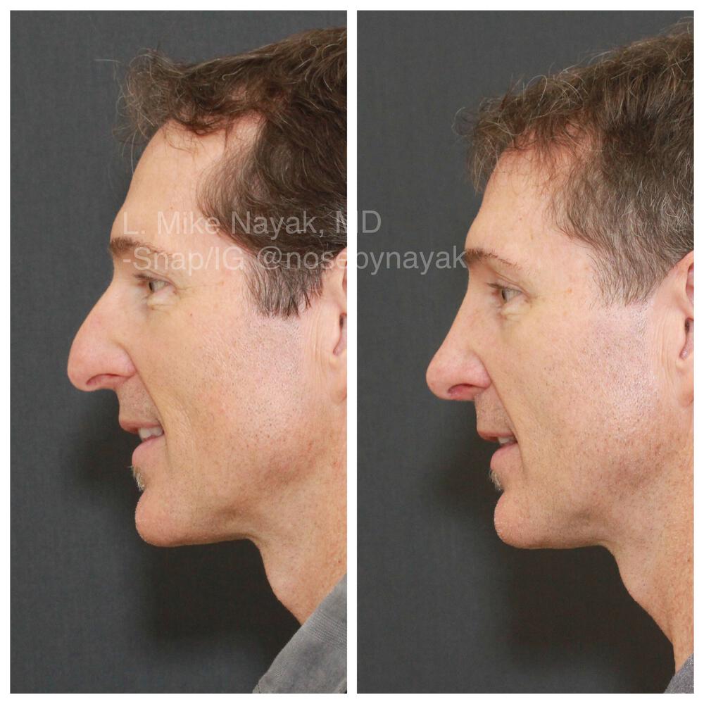 Rhinoplasty Before & After Image