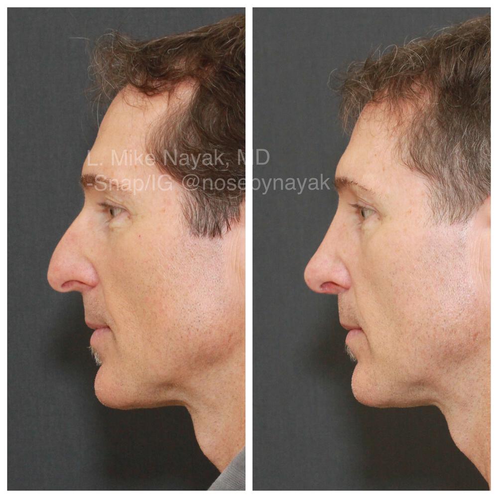 Rhinoplasty Before & After Image