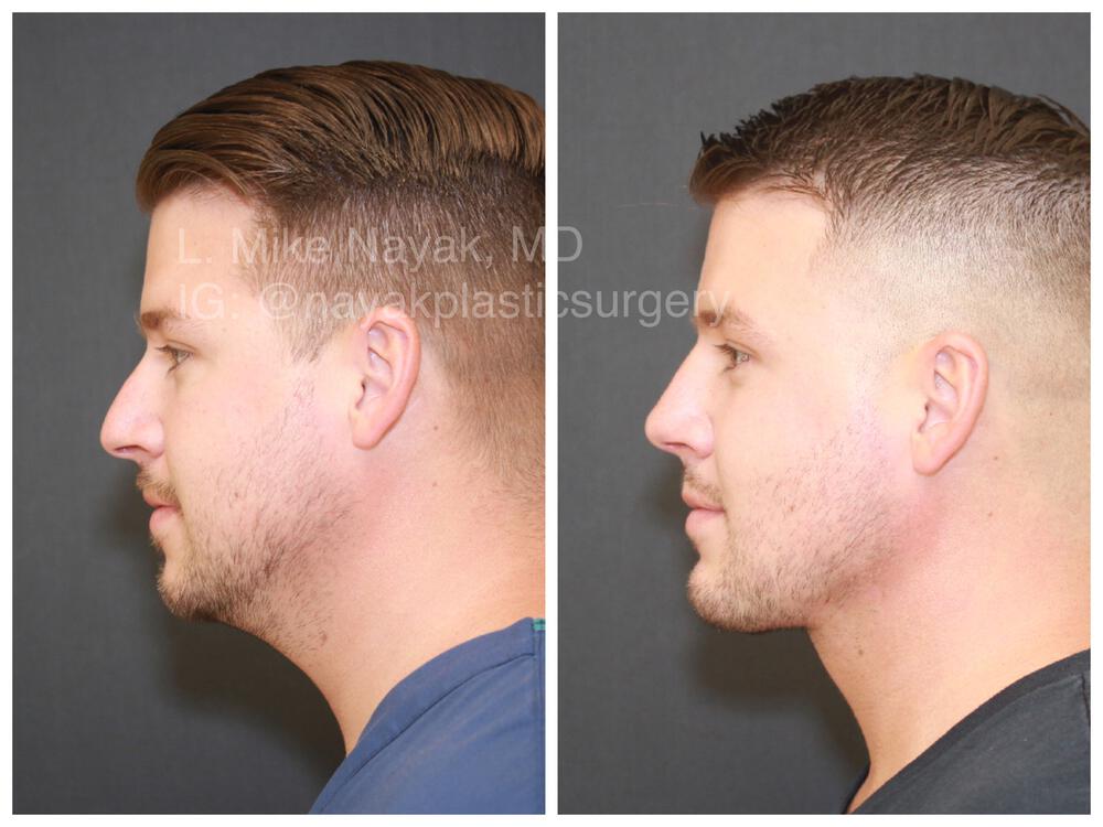 Rhinoplasty Before & After Image