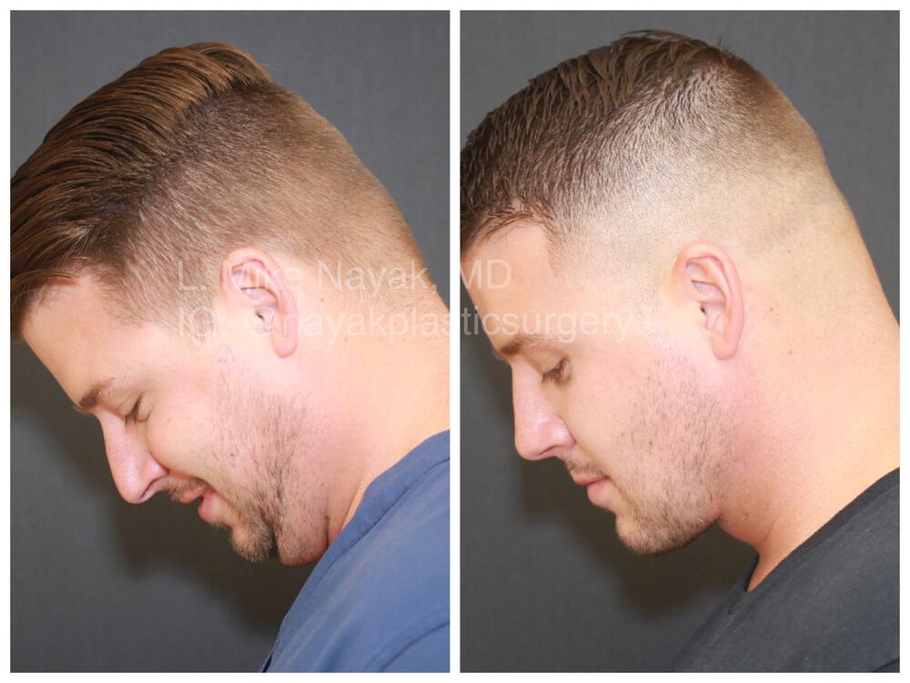 Rhinoplasty Before & After Image