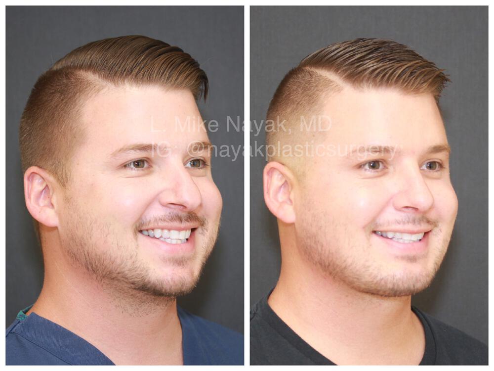 Rhinoplasty Before & After Image