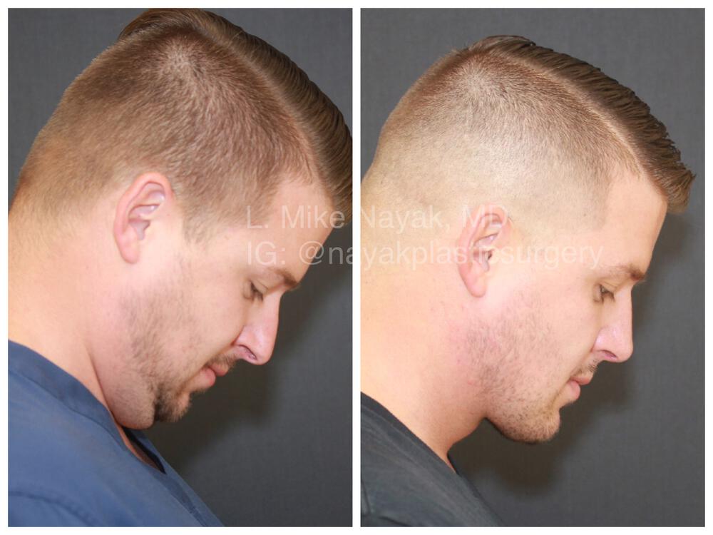 Rhinoplasty Before & After Image