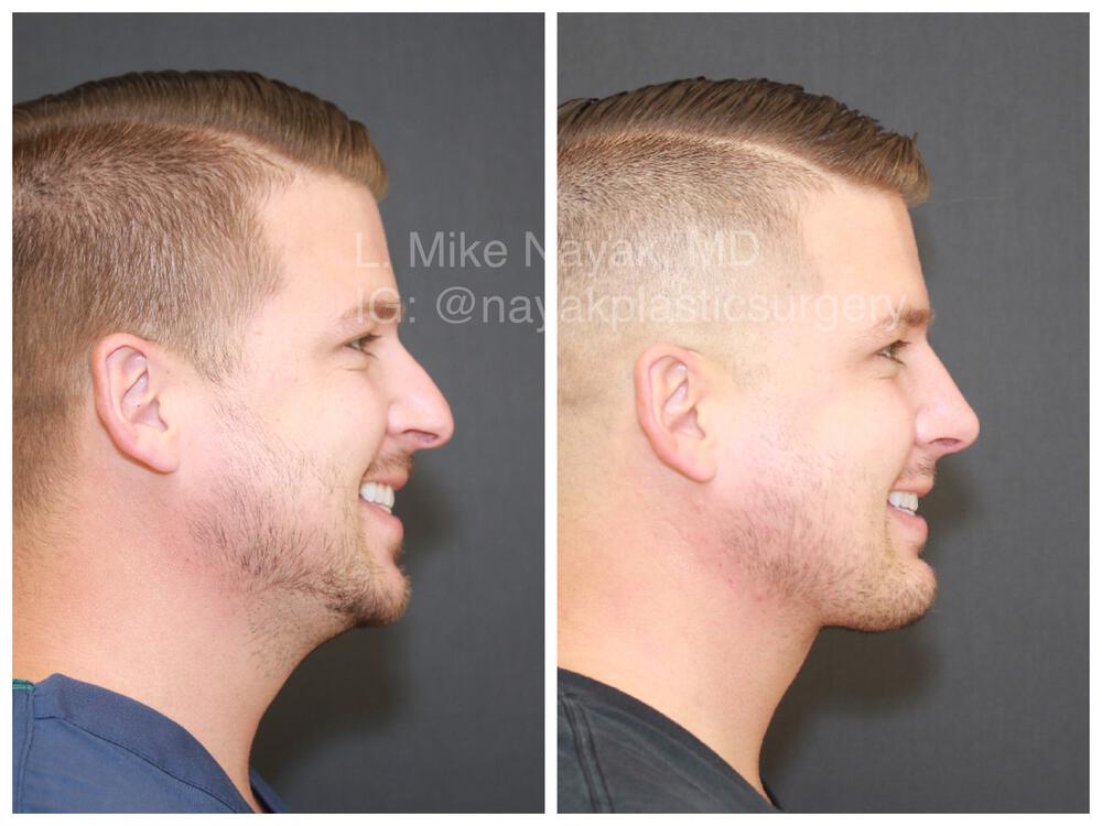 Rhinoplasty Before & After Image