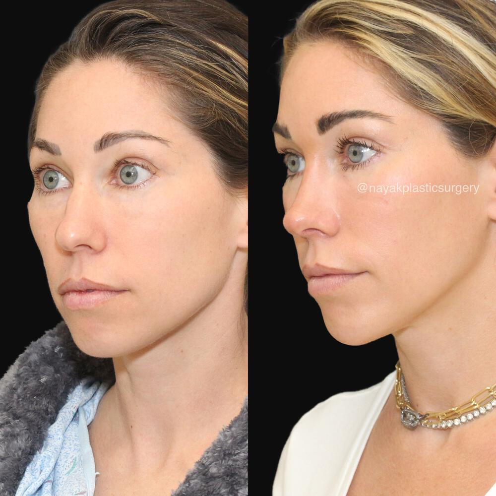 Rhinoplasty Before & After Image