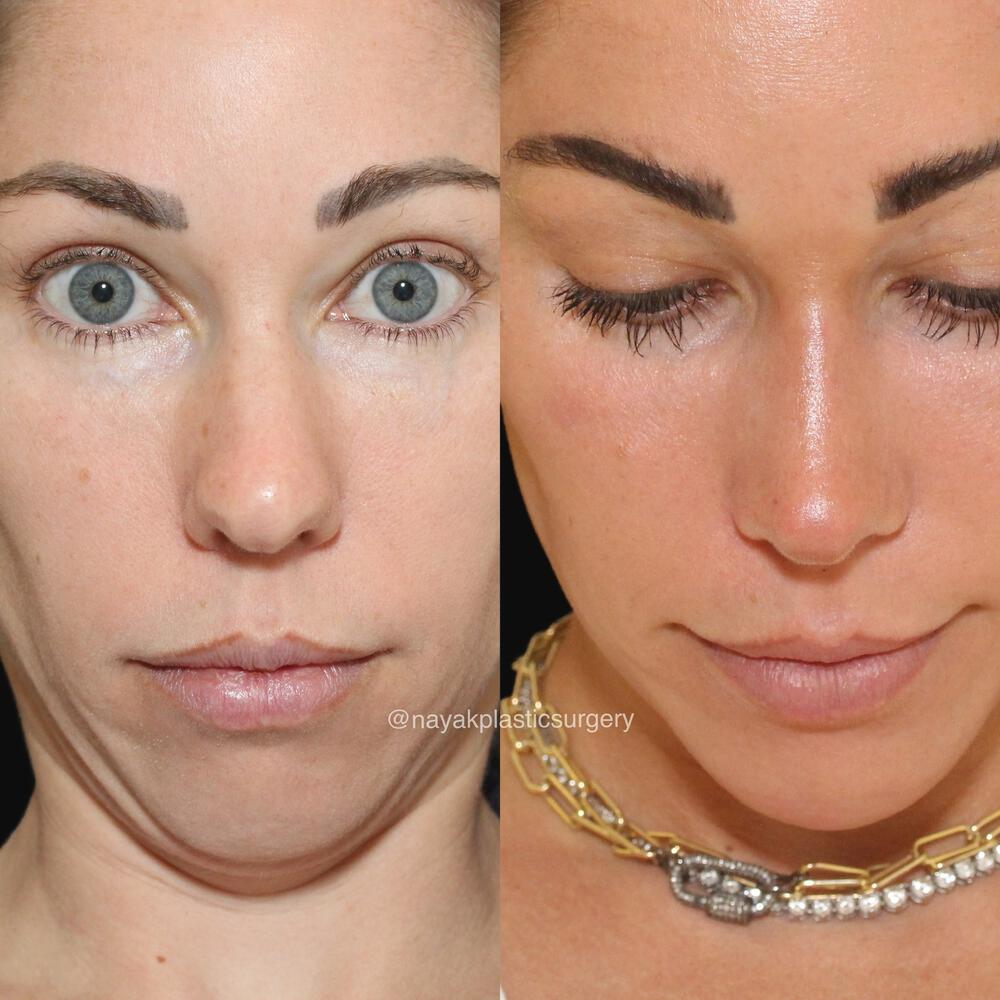 Rhinoplasty Before & After Image