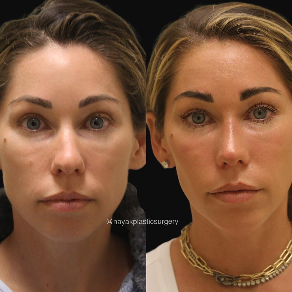 Rhinoplasty Before & After Image