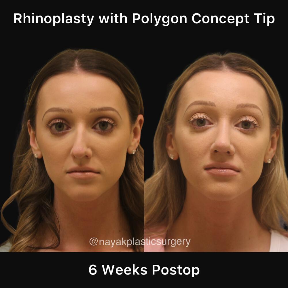 Rhinoplasty Before & After Image