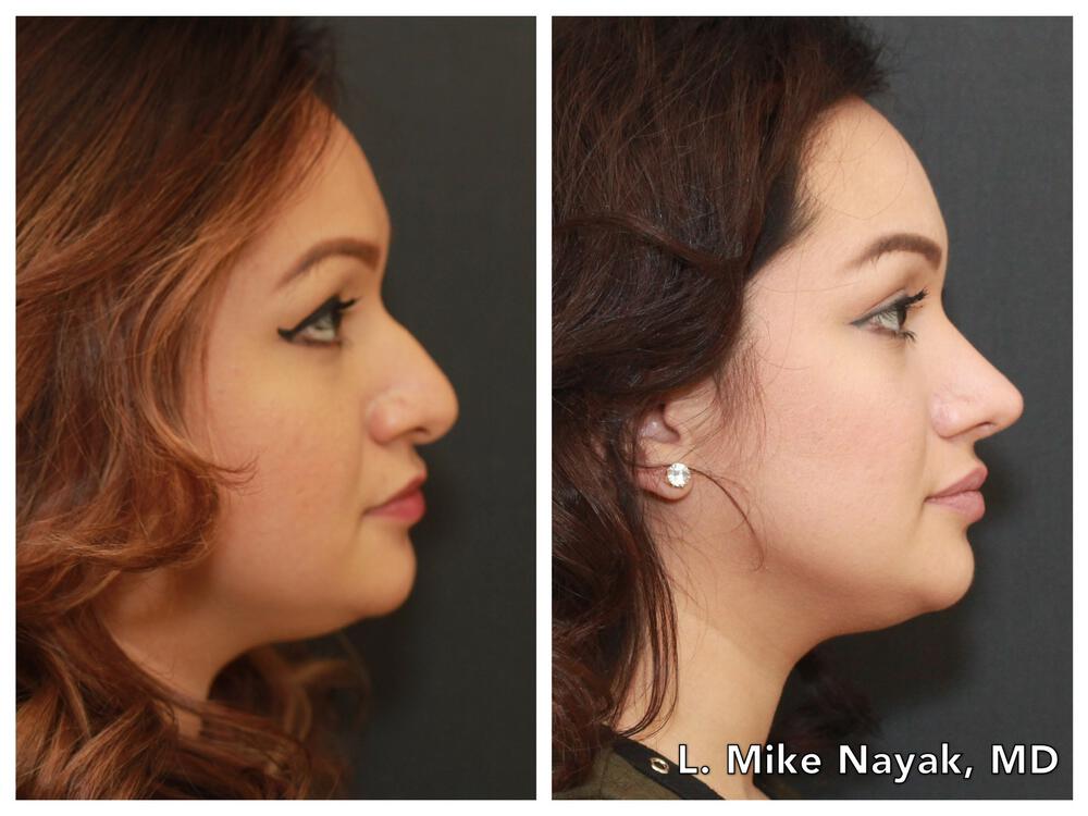 Rhinoplasty Before & After Image