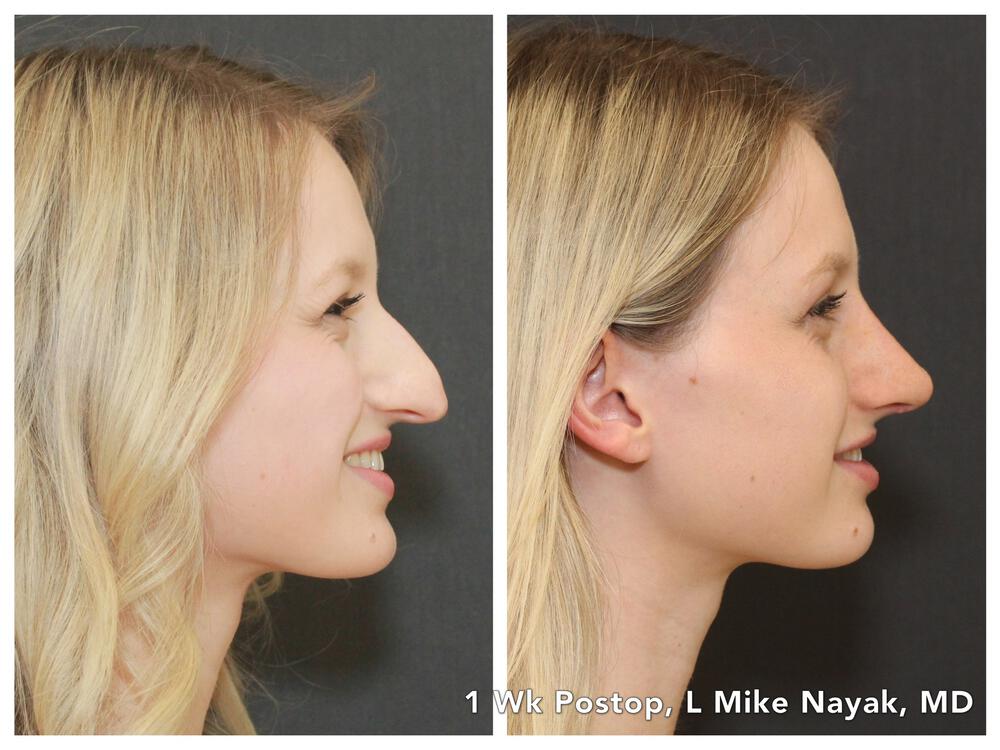 Rhinoplasty Before & After Image