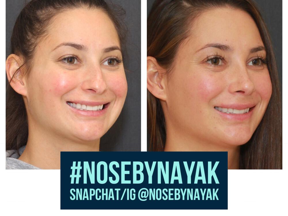 Rhinoplasty Before & After Image