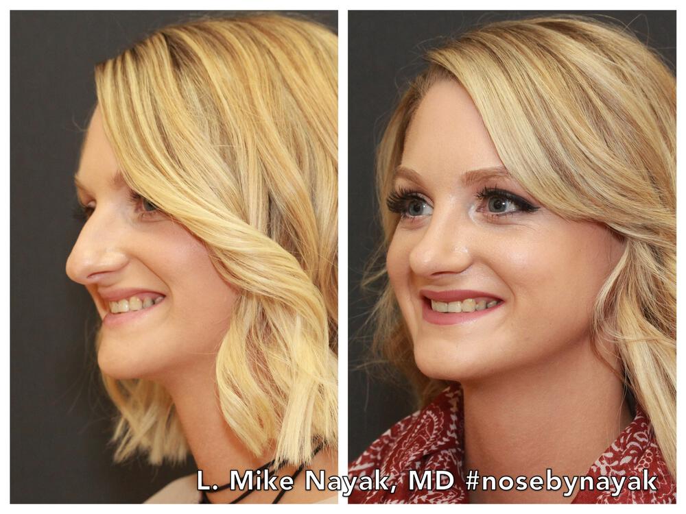 Rhinoplasty Before & After Image