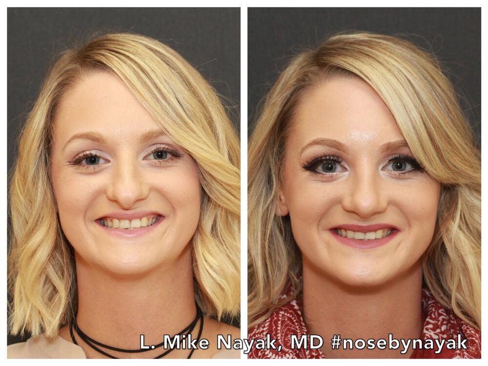 Rhinoplasty Before & After Image