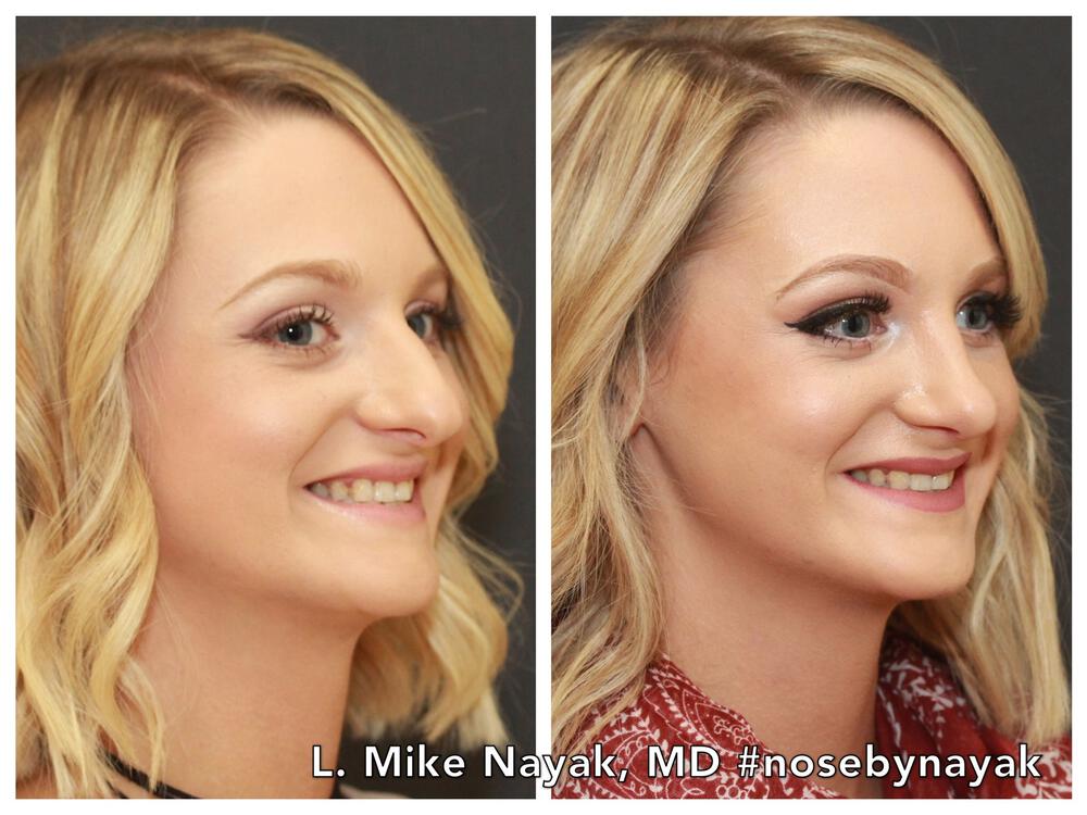 Rhinoplasty Before & After Image