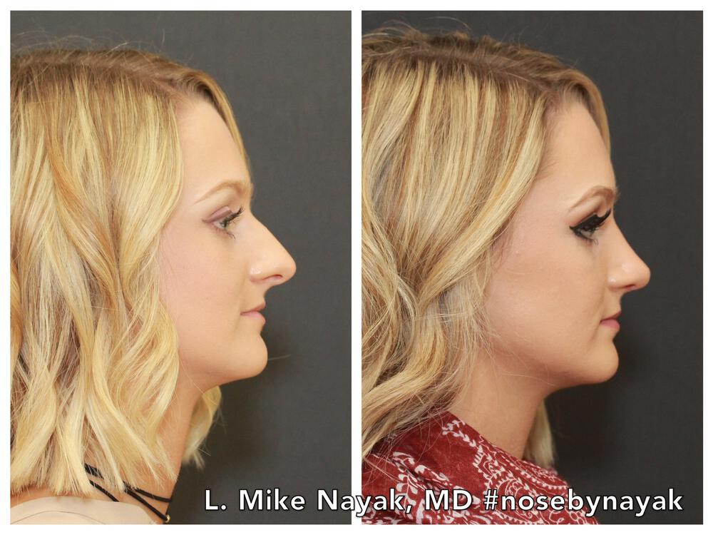 Rhinoplasty Before & After Image