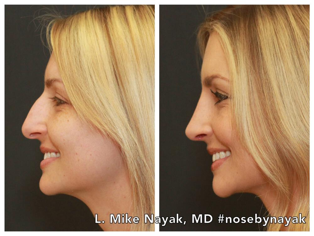 Rhinoplasty Before & After Image