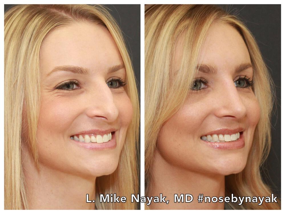 Rhinoplasty Before & After Image