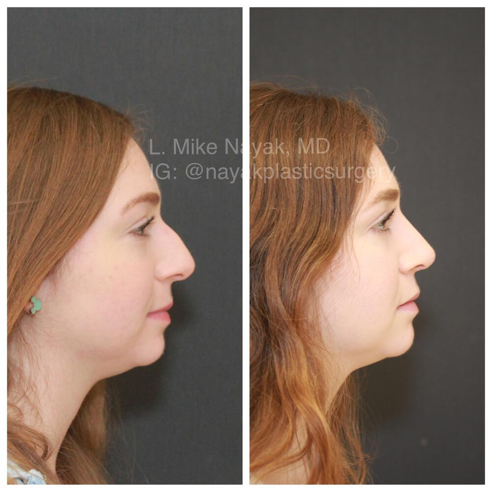 Rhinoplasty Before & After Image