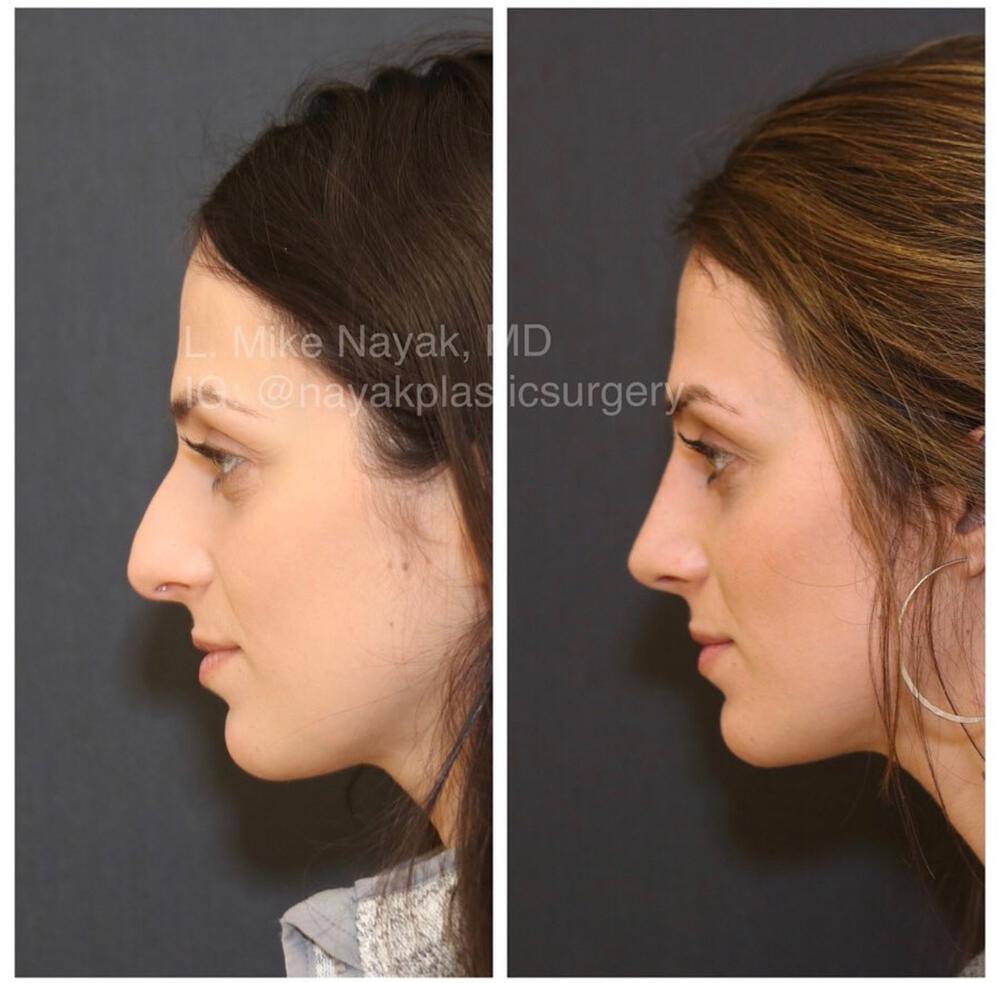 Rhinoplasty Before & After Image