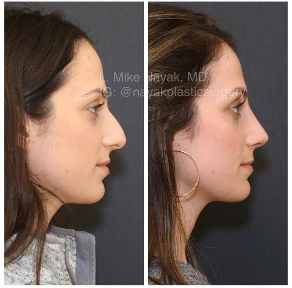 Rhinoplasty Before & After Image