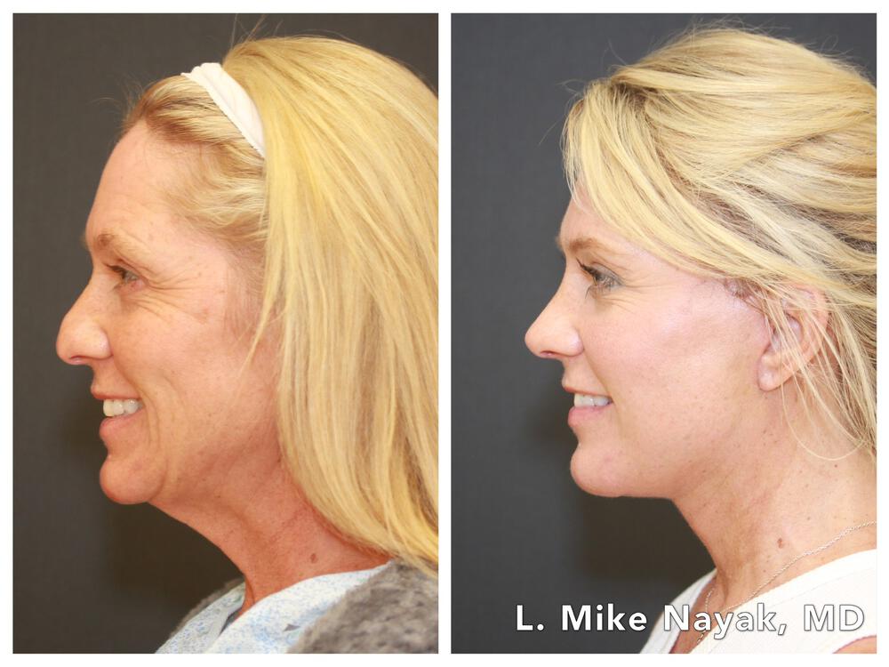 Rhinoplasty Before & After Image