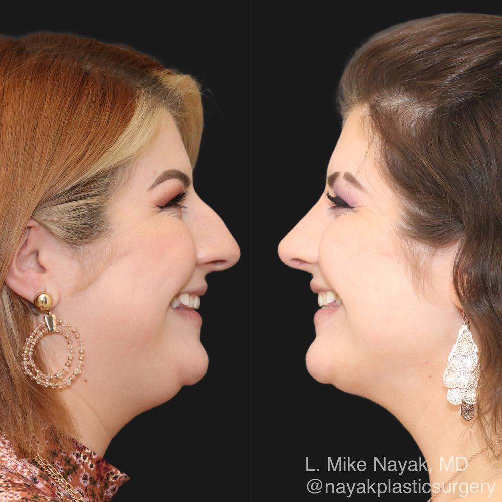 Rhinoplasty Before & After Image