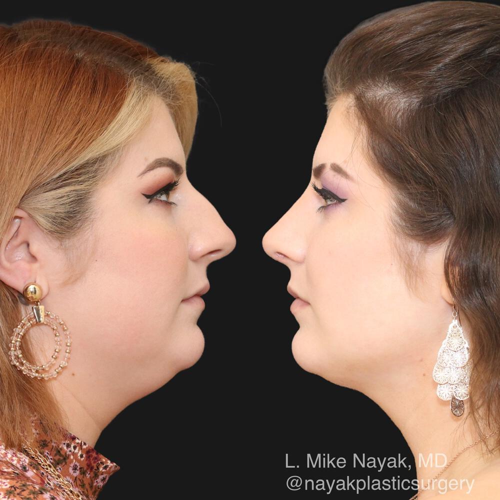 Rhinoplasty Before & After Image