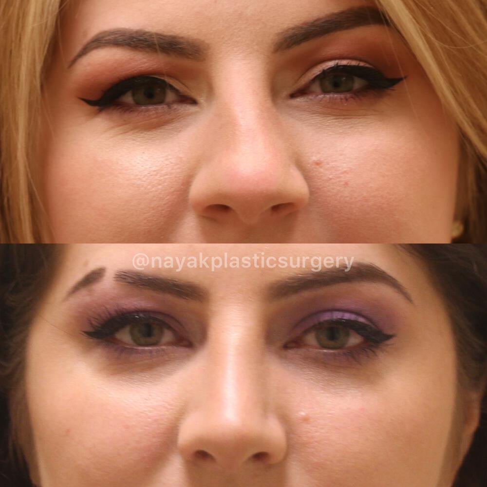 Rhinoplasty Before & After Image