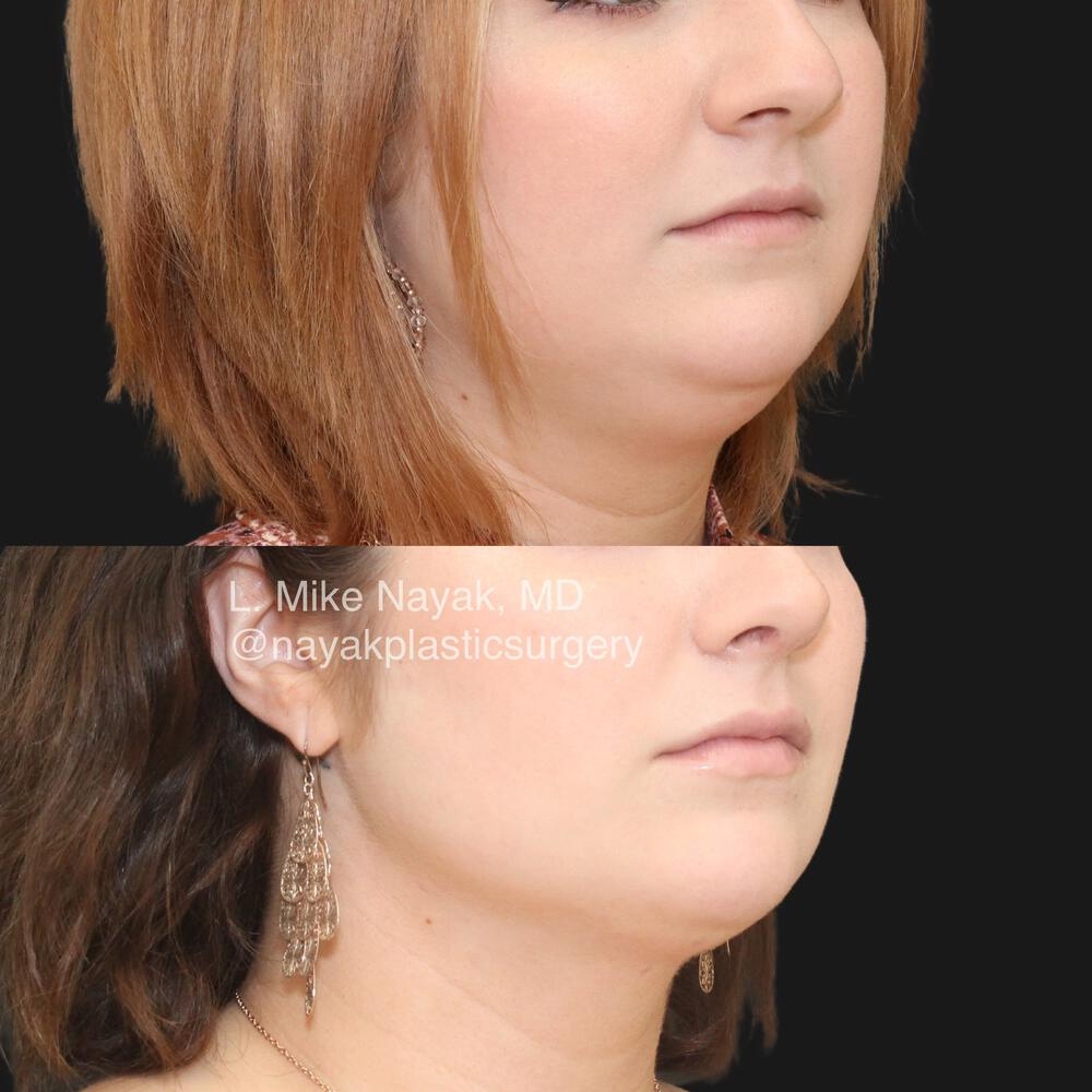 Rhinoplasty Before & After Image