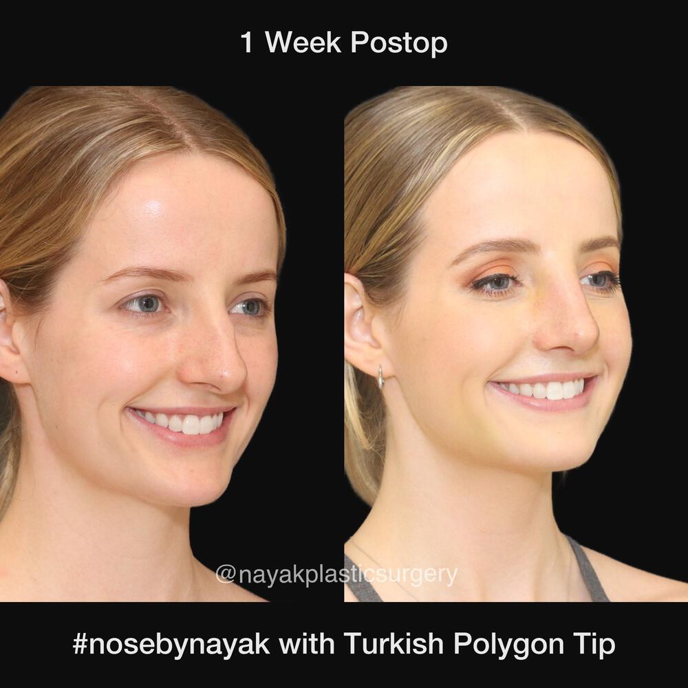 Rhinoplasty Before & After Image