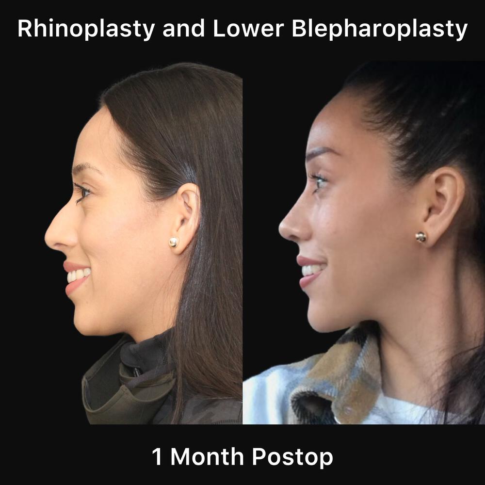 Rhinoplasty Before & After Image