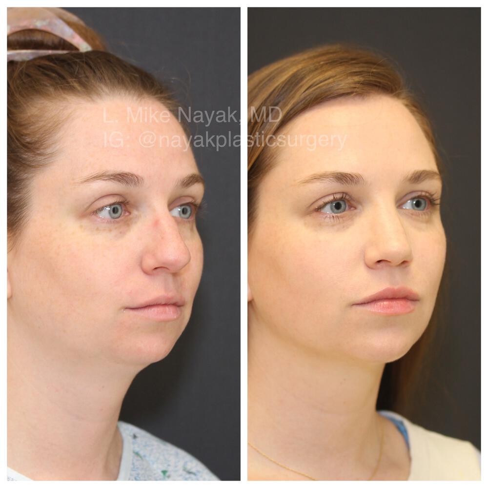 Rhinoplasty Before & After Image