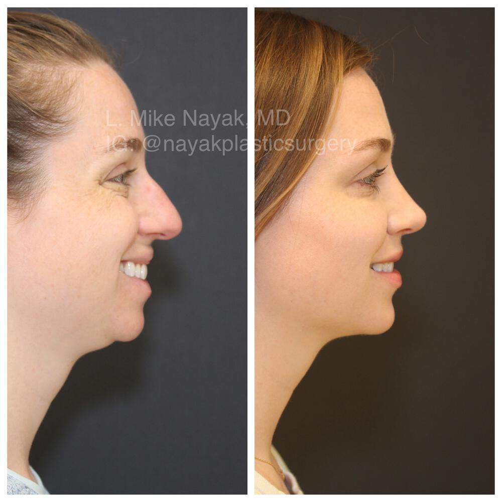 Rhinoplasty Before & After Image