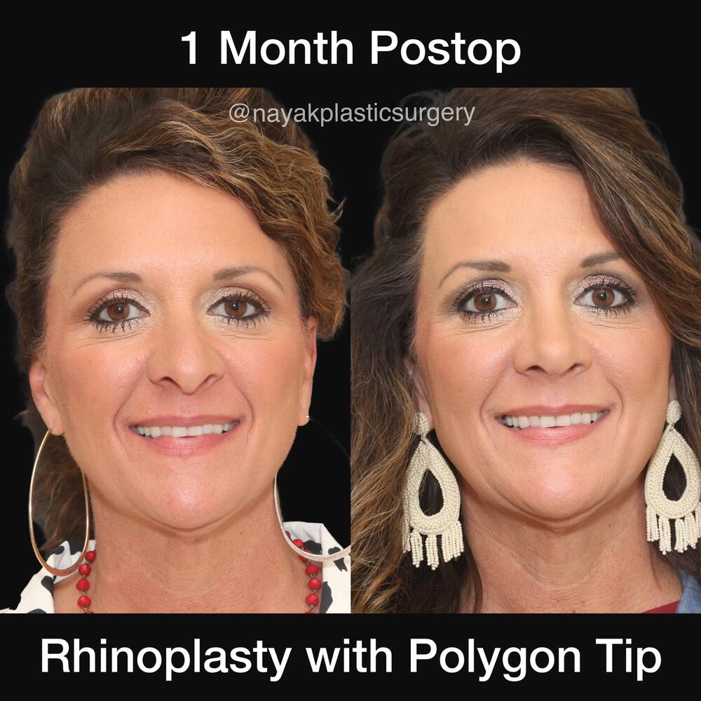 Rhinoplasty Before & After Image