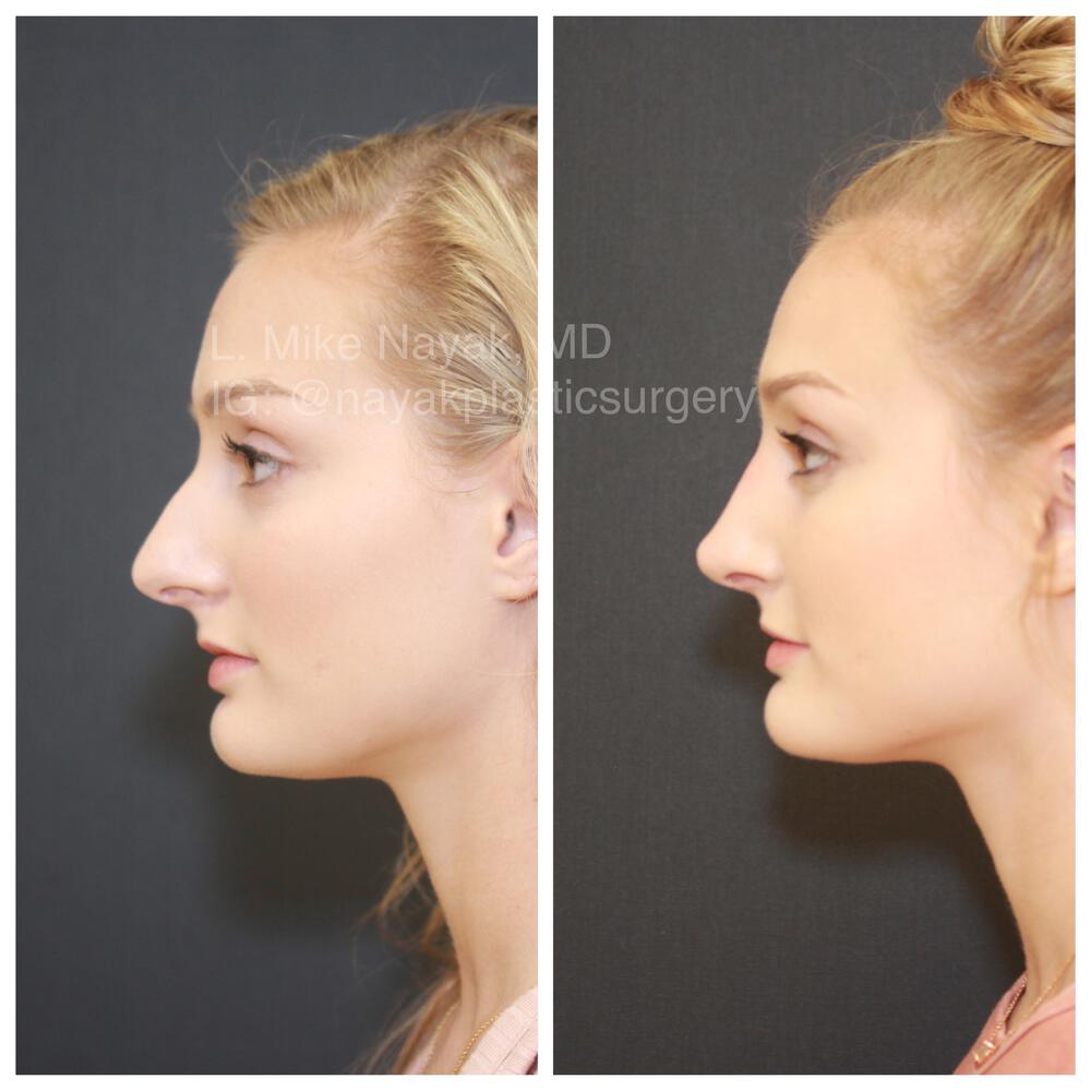 Rhinoplasty Before & After Image